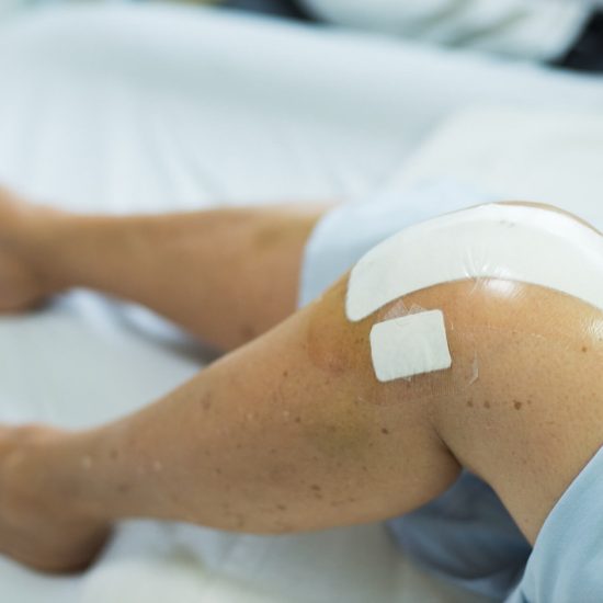 Close up of knee replacement surgery after operation. Patient on the bed in hospital gown.