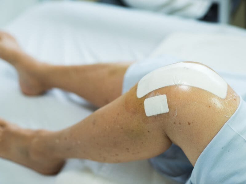 Close up of knee replacement surgery after operation. Patient on the bed in hospital gown.