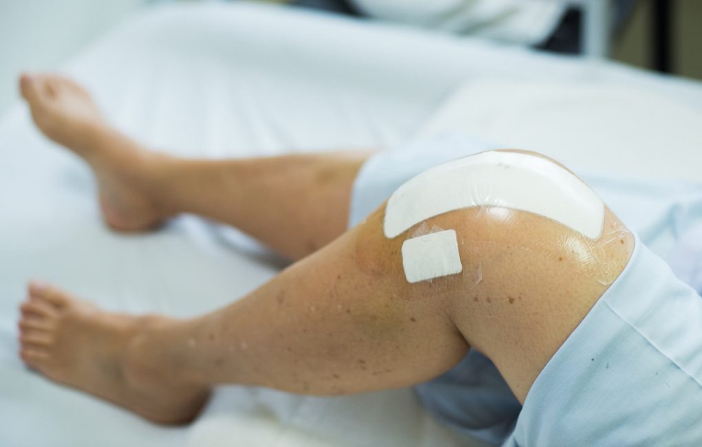 Close up of knee replacement surgery after operation. Patient on the bed in hospital gown.